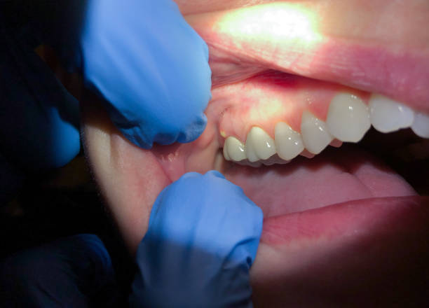 Best Urgent Tooth Repair  in Grenelefe, FL
