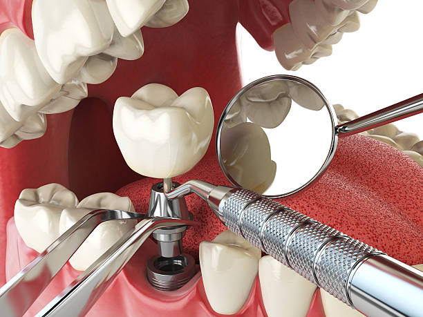 Best Chipped Tooth Repair Near Me  in Grenelefe, FL